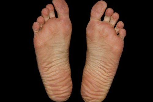 足底腱膜炎の症状