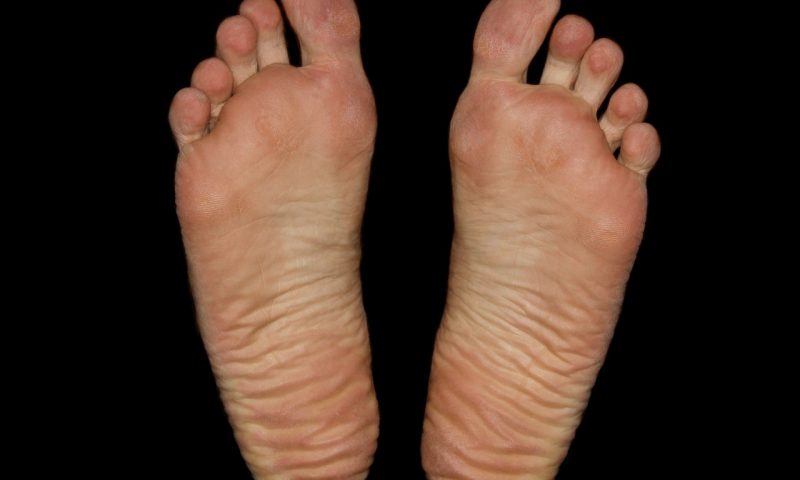 足底腱膜炎の症状