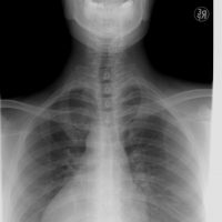 胸郭出口症候群の手術