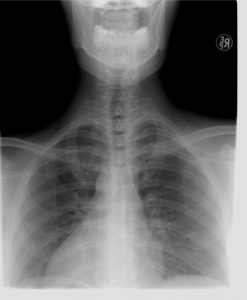 胸郭出口症候群の手術